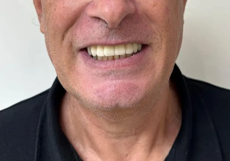 Dopo: arcata completa con denti fissi su impianti