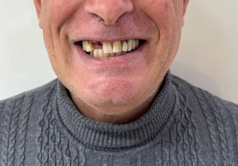 Prima: arcata con denti mancanti e compromessi