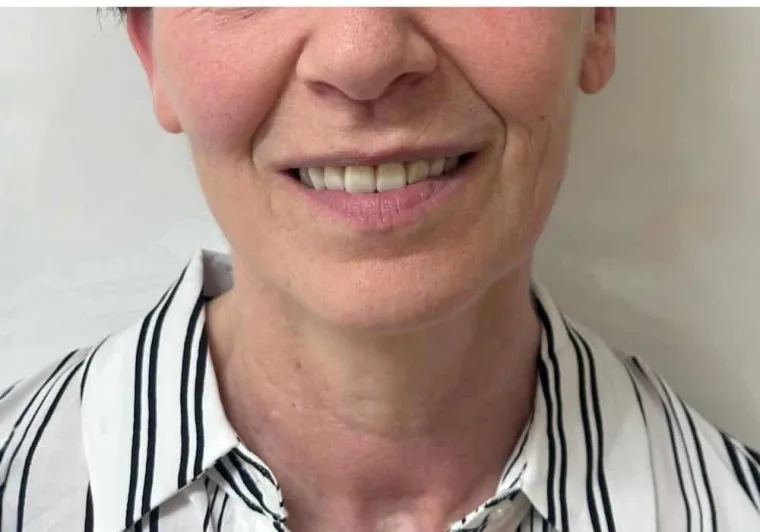 Dopo: sorriso armonico con protesi fissa su impianti
