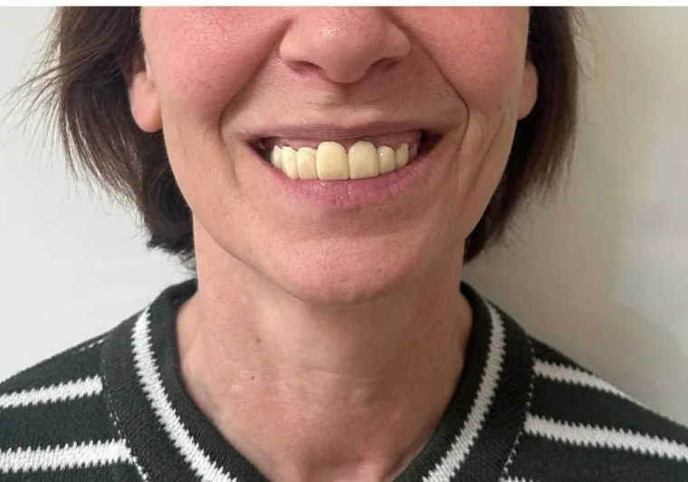 Prima: denti usurati e disallineati