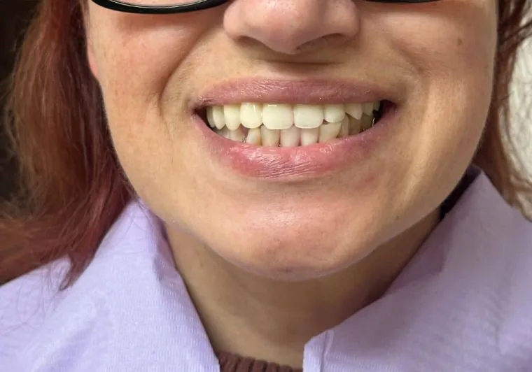 Dopo: linea del sorriso naturale e uniforme