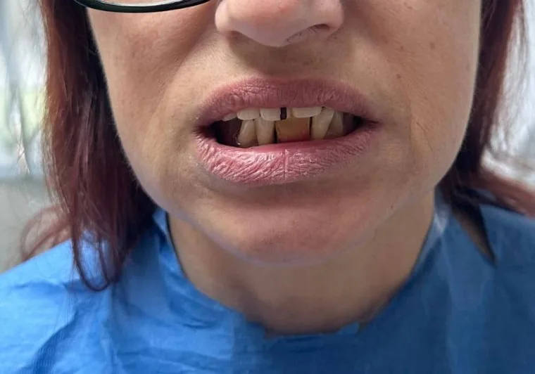 Prima: denti anteriori rovinati