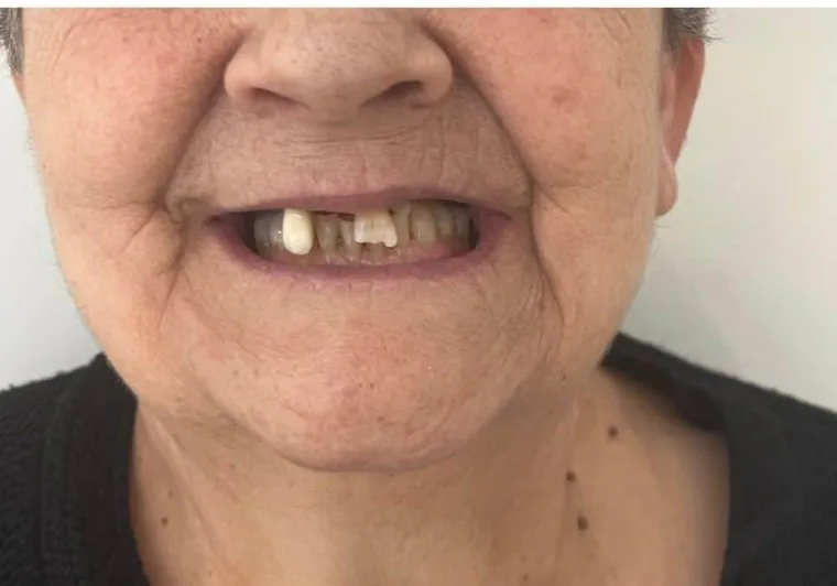 Prima: pochi denti residui e compromessi