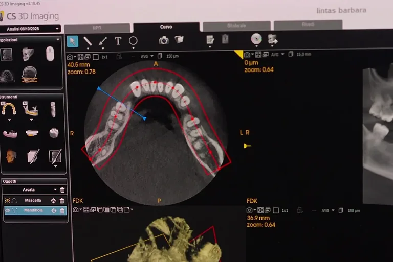 Endodonzia e devitalizzazione