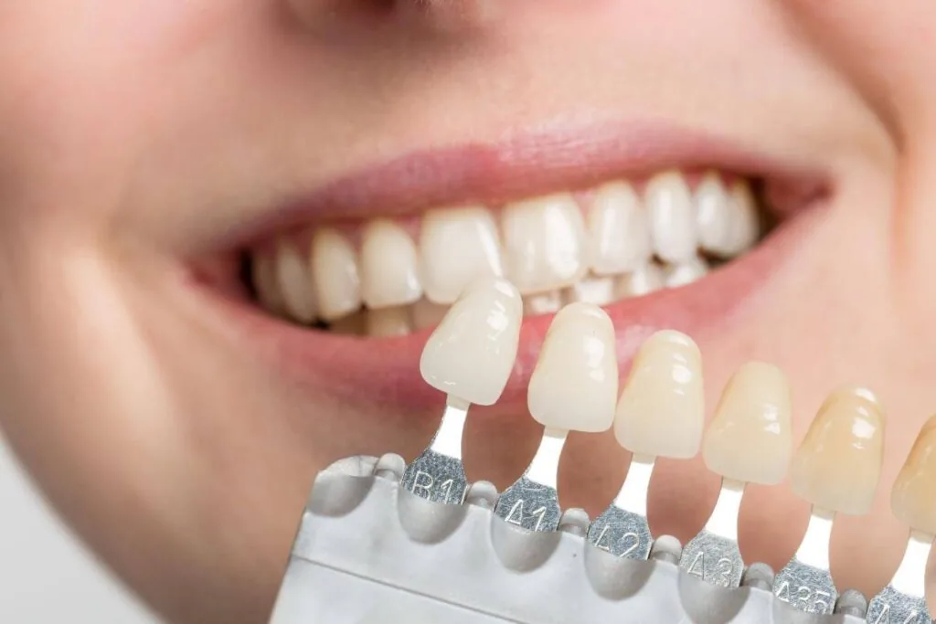 Scelta del colore delle faccette con scala colori dentale — estetica dentale a Olbia
