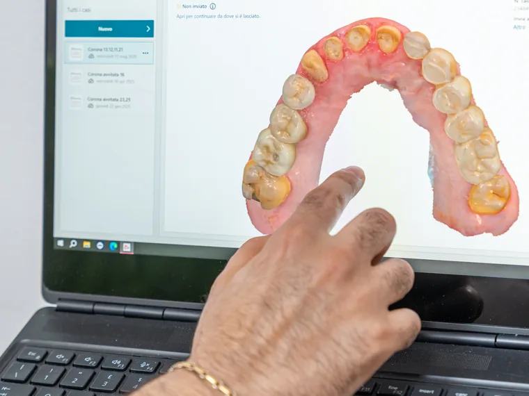 Contenzione a fine trattamento per mantenere il risultato