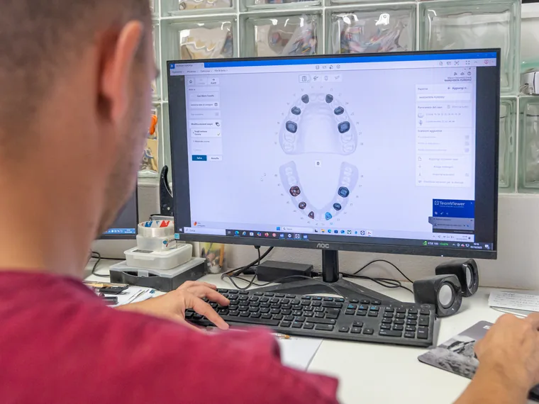 Progettazione digitale della protesi al computer