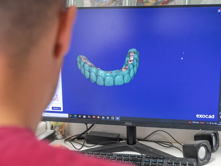 Impronta digitale con scanner intraorale per la protesi
